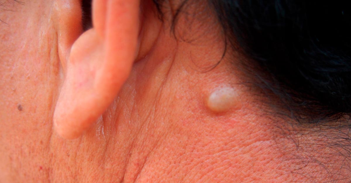 Cirurgia-de-cisto-sebaceo-saiba-como-funciona-e-os-cuidados-pos-cirurgico